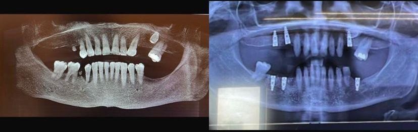 Case 1: panoramic radiograph before and after treatment, Primo Dental Clinic Tirana