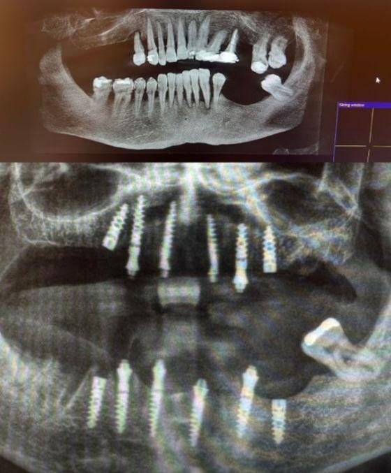 Case 3: panoramic radiograph before and after treatment, Primo Dental Clinic Tirana