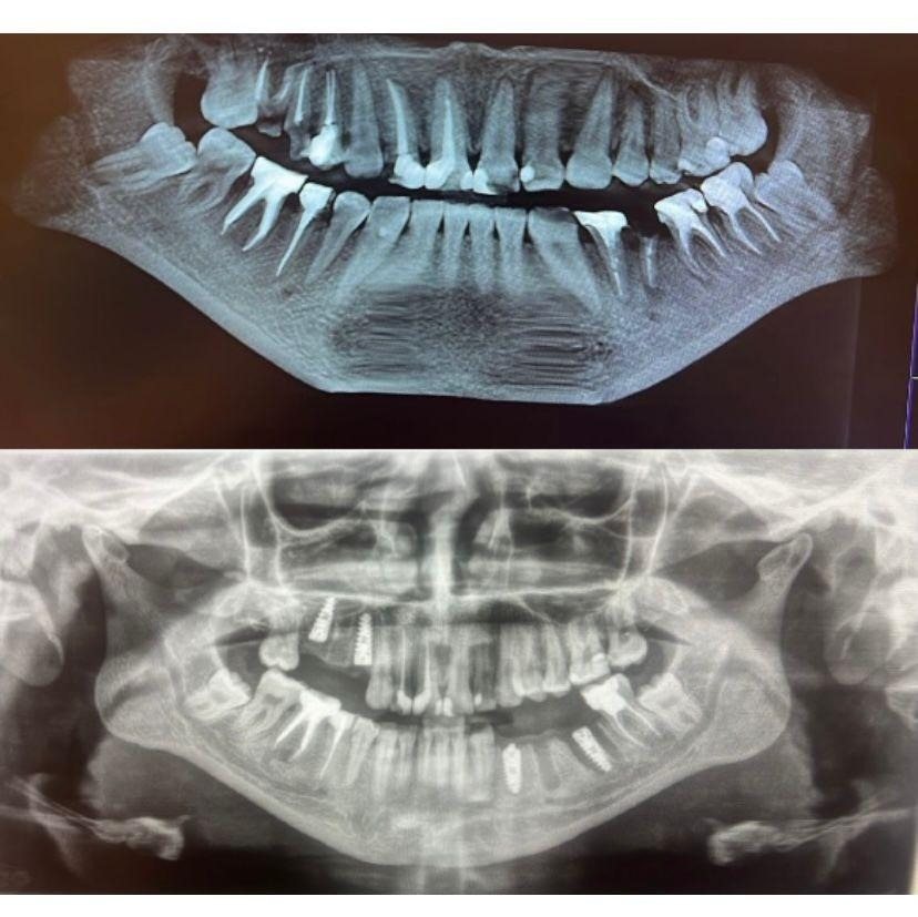 Case 4: panoramic radiograph before and after treatment, Primo Dental Clinic Tirana