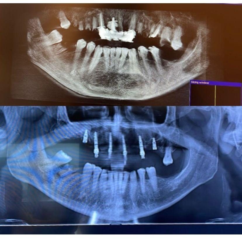Case 5: panoramic radiograph before and after treatment, Primo Dental Clinic Tirana