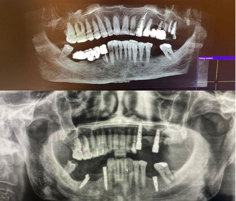 Case 6: panoramic radiograph before and after treatment, Primo Dental Clinic Tirana