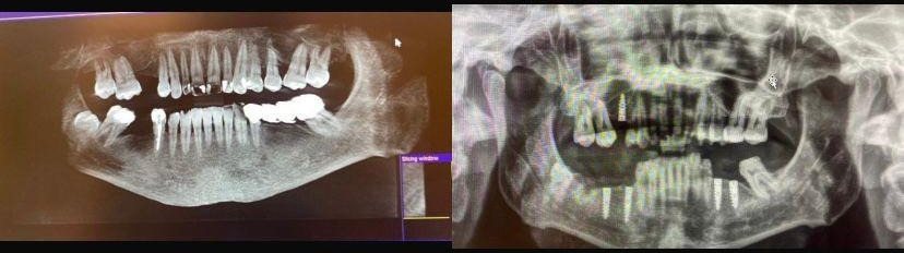 Case 10: panoramic radiograph before and after treatment, Primo Dental Clinic Tirana