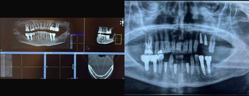 Case 11: panoramic radiograph before and after treatment, Primo Dental Clinic Tirana
