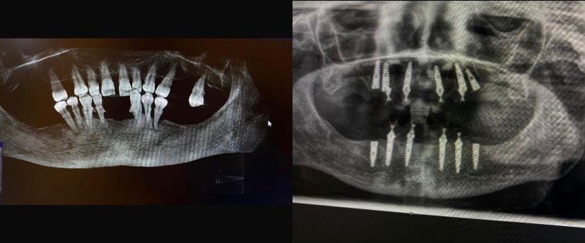 Case 15: panoramic radiograph before and after treatment, Primo Dental Clinic Tirana