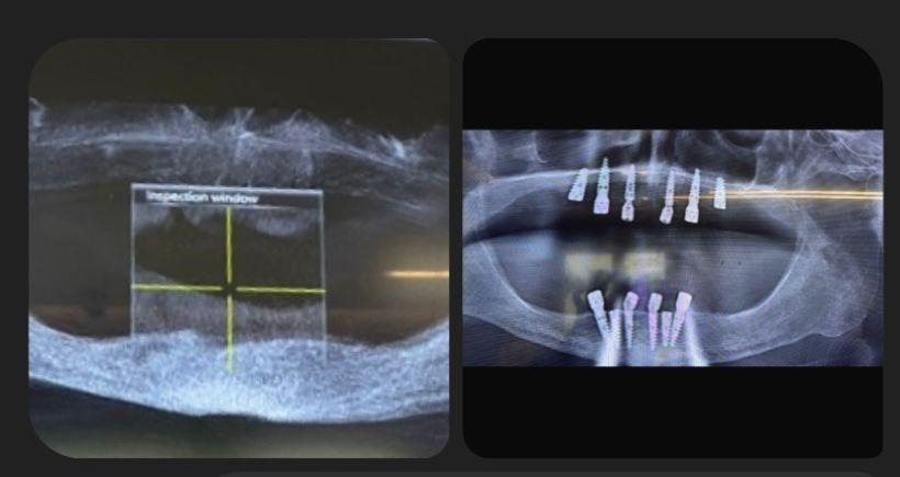 Case 16: panoramic radiograph before and after treatment, Primo Dental Clinic Tirana